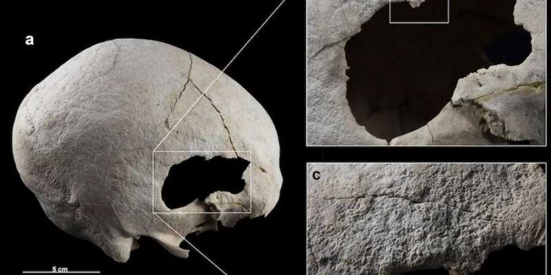 Рідкісне явище. В Іспанії знайшли скелет жінки, яка 4500 років тому пережила дві трепанації черепа